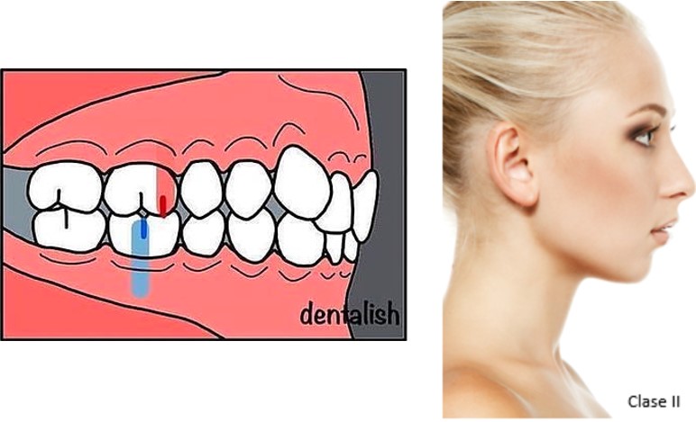 Maloclusión Clase 2
