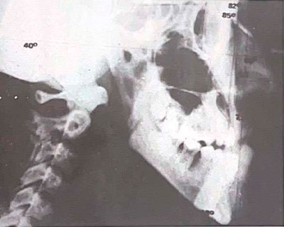 Prognatismo y Desviación Facial