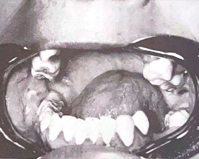 Anquilosis de Articulación Temporomandibular