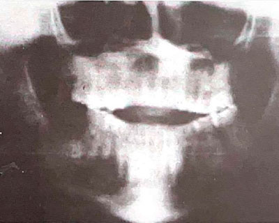 La boca y la medicina – Alteraciones de la Articulación témporo-mandibular con artritis reumatoide