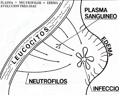 La boca y la medicina – Infección en las regiones bucal y maxilofacial