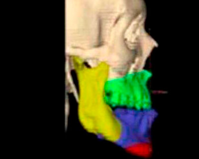 Digital Flow para obtener guías quirúrgicas y placas personalizadas en mínimos procedimientos invasivos (MIS) para cirugía ortognát