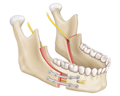 La Osteotomía Sagital Intraoral de la Mandíbula