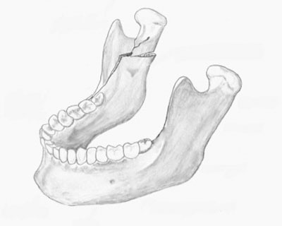 Estabilidad mandibular después de la osteotomía sagital y fijación