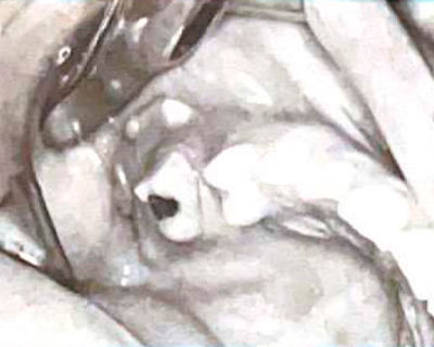 Erupción de odontoma complejo a la cavidad oral