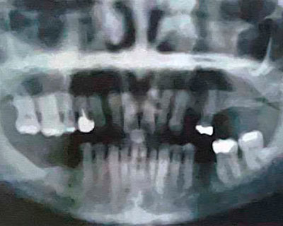 Los Implantes dentales