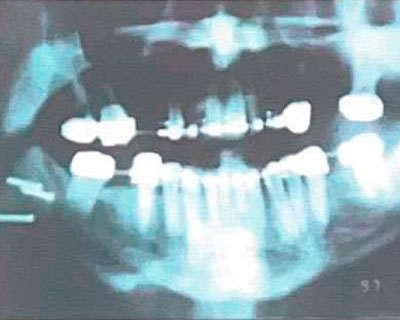 Estabilidad esquelética en la osteotomía sagital mandibular