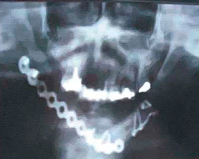 Reconstrucción de mandíbula en pacientes radiados